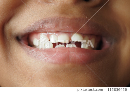 detail shot of child with teeth missing 115836456