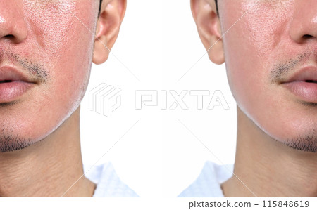 Comparison of skin before and after laser treatment, skin with acne scars and enlarged pores Comparison of skin before and after laser treatment, skin with acne scars and enlarged pores 115848619