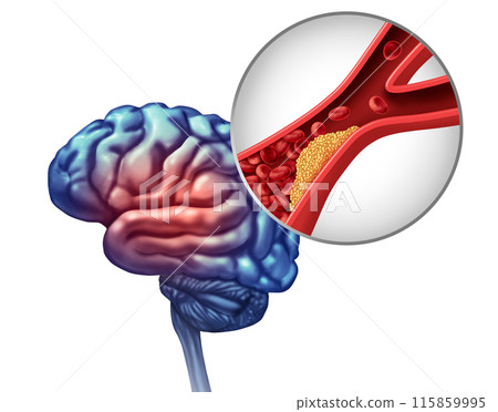 Mini Stroke Mini Stroke 115859995