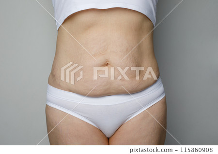 Female skin with striae after pregnancy or overweight on white background 115860908