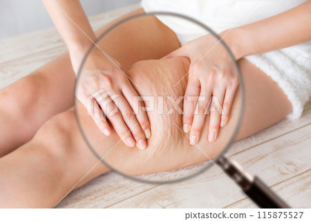 A magnifying glass is used to magnify cellulite on a woman's thighs. 115875527