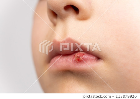 Skin damage, wound, abrasion on the lip of a small child. 115879920