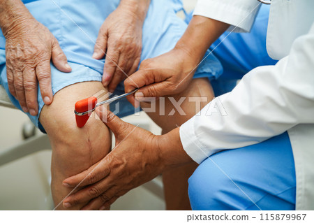 Doctor neurologist testing reflex knee with hammer and show Asian senior scars surgical total knee joint replacement. 115879967