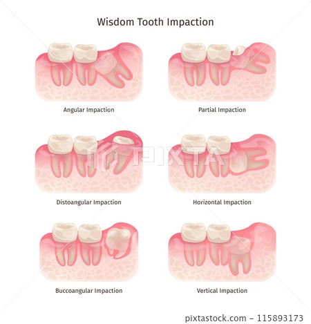 Wisdom tooth. Wisdoms teeth dental problem, molar extraction root canal bone or gum pain surgery treatment remove teeths dentist x ray infographic, swanky illustration Wisdom tooth. Wisdoms teeth dental problem, molar extraction root canal bone or gum pain surgery treatment remove teeths dentist x ray infographic, swanky illustration 115893173