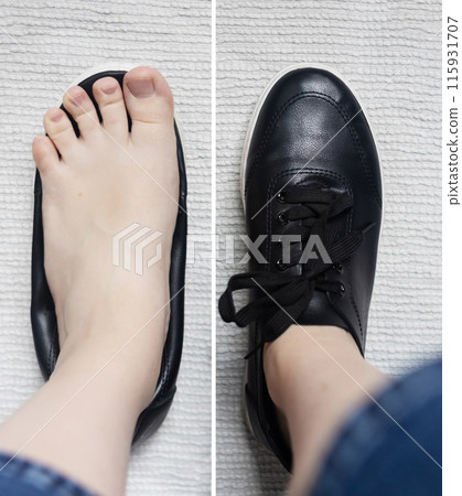 Foot deforming shoes. Incorrect anatomical shoes with flat soles. Small insole size, which causes foot pain. Cause of valgus, calluses, ingrown toenails 115931707