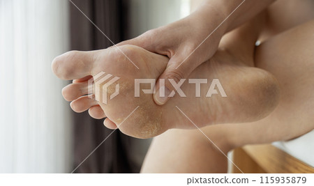 dirty and neglected feet dirty and neglected feet 115935879