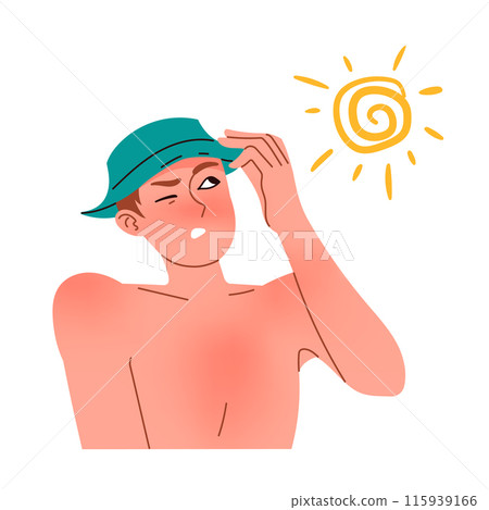 Man gets sunburns from the sun, red skin after UV 115939166