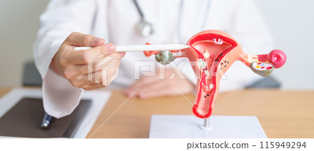 Doctor with Uterus and Ovaries anatomy model. Ovarian and Cervical cancer, Cervix disorder, Endometriosis, Hysterectomy, Uterine fibroids, Reproductive system, Pregnancy and health concept 115949294