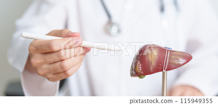 Doctor with human Liver anatomy model. Liver cancer and Tumor, Jaundice, Viral Hepatitis A, B, C, D, E, Cirrhosis, Failure, Enlarged, Hepatic Encephalopathy, Ascites Fluid in Belly and health concept 115949355