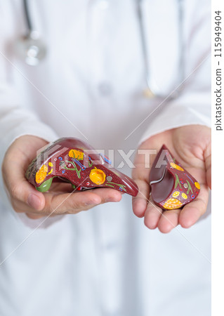 Doctor holding human Liver anatomy model. Liver cancer and Tumor, Jaundice, Viral Hepatitis A, B, C, D, E, Cirrhosis, Failure, Enlarged, Hepatic Encephalopathy, Ascites Fluid in Belly and health Doctor holding human Liver anatomy model. Liver cancer and Tumor, Jaundice, Viral Hepatitis A, B, C, D, E, Cirrhosis, Failure, Enlarged, Hepatic Encephalopathy, Ascites Fluid in Belly and health 115949404