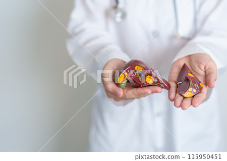 Doctor holding human Liver anatomy model. Liver cancer and Tumor, Jaundice, Viral Hepatitis A, B, C, D, E, Cirrhosis, Failure, Enlarged, Hepatic Encephalopathy, Ascites Fluid in Belly and health 115950451