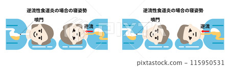 男性和女性胃酸逆流/逆流性食道炎的睡姿圖解 男性和女性胃酸逆流/逆流性食道炎的睡姿圖解 115950531