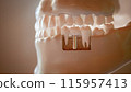 Dental Implant Procedure 3D Rendering 115957413