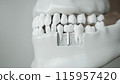 Dental Implant in Jaw 3D Rendering 115957420
