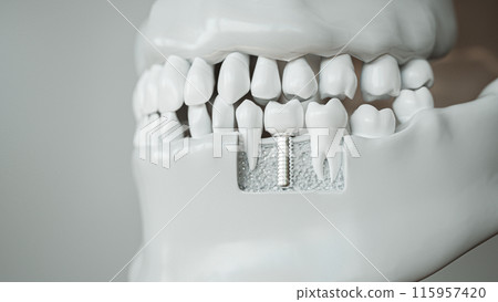 Dental Implant in Jaw 3D Rendering Dental Implant in Jaw 3D Rendering 115957420