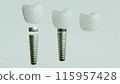 Dental Implants 3D Rendering 115957428