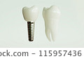 Dental Implant Comparison 3D Rendering 115957436