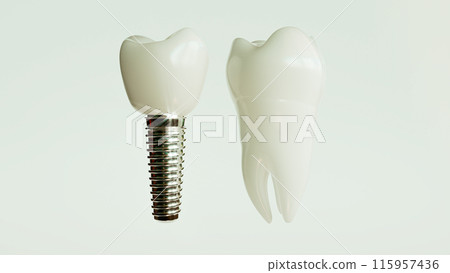 Dental Implant Comparison 3D Rendering 115957436