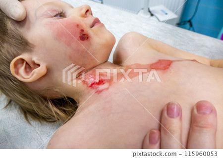 dressing a boy with a burn from boiling water dressing a boy with a burn from boiling water 115960053