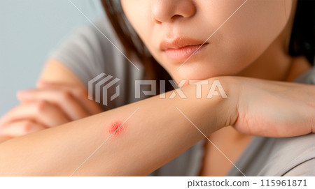 Woman's arm suffering from insect bites 115961871