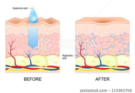 Hyaluronic acid. Skin rejuvenation 115963708