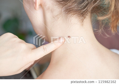 Woman examing her abnormal mole. Dermatology procedure. Doctor checking 115982102