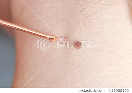 Woman examing her abnormal mole. Dermatology procedure. Doctor checking Woman examing her abnormal mole. Dermatology procedure. Doctor checking 115982103