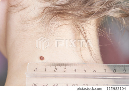 Woman examing her abnormal mole. Dermatology procedure. Doctor checking 115982104