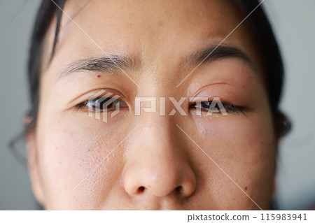 Woman's eyes become inflamed after rubbing her eyes violently. Insects entering eye cause irritation and wounds to cornea, causing eye to become swollen and red. Ophthalmologist treats eye infections. Woman's eyes become inflamed after rubbing her eyes violently. Insects entering eye cause irritation and wounds to cornea, causing eye to become swollen and red. Ophthalmologist treats eye infections. 115983941