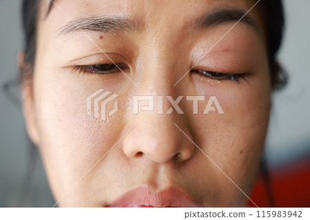 Woman's eyes become inflamed after rubbing her eyes violently. Insects entering eye cause irritation and wounds to cornea, causing eye to become swollen and red. Ophthalmologist treats eye infections. Woman's eyes become inflamed after rubbing her eyes violently. Insects entering eye cause irritation and wounds to cornea, causing eye to become swollen and red. Ophthalmologist treats eye infections. 115983942
