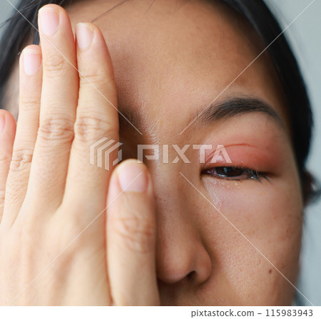 Woman's eyes become inflamed after rubbing her eyes violently. Insects entering eye cause irritation and wounds to cornea, causing eye to become swollen and red. Ophthalmologist treats eye infections. Woman's eyes become inflamed after rubbing her eyes violently. Insects entering eye cause irritation and wounds to cornea, causing eye to become swollen and red. Ophthalmologist treats eye infections. 115983943