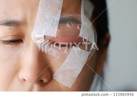 Asian woman's covered eye with plastic clear shields protective irritation and wounds to cornea, causing eye to become swollen and red. eye become inflamed. Ophthalmologist treats eye infections. Asian woman's covered eye with plastic clear shields protective irritation and wounds to cornea, causing eye to become swollen and red. eye become inflamed. Ophthalmologist treats eye infections. 115983956