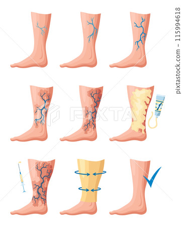 Stages or types of varicose veins development. Medical poster or disease infographic. Image of healthy and diseased legs. Vector illustration in flat style Stages or types of varicose veins development. Medical poster or disease infographic. Image of healthy and diseased legs. Vector illustration in flat style 115994618