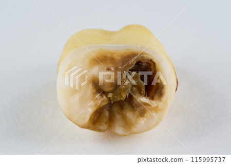 Extracted tooth and white background Extracted tooth and white background 115995737
