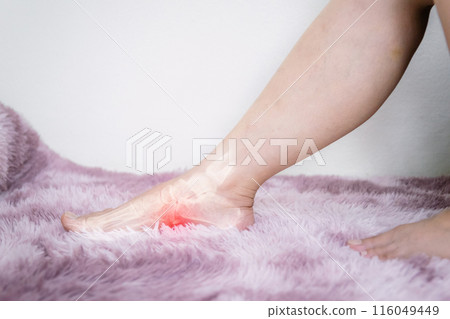Foot plantar fasciitis and plantar inflammation 116049449