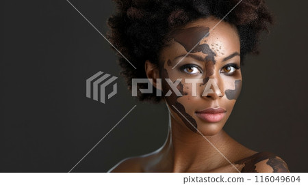Portrait Of African Woman With Vitiligo Disease, Skin Depigmentation, Natural Beauty And Diversity 116049604