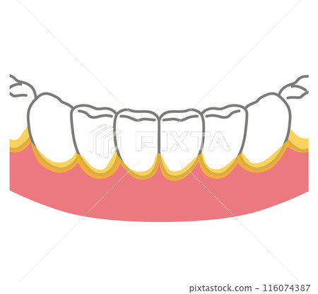 Plaque that has accumulated at the border between the teeth and gums Toothbrushing Remaining areas Plaque that has accumulated at the border between the teeth and gums Toothbrushing Remaining areas 116074387