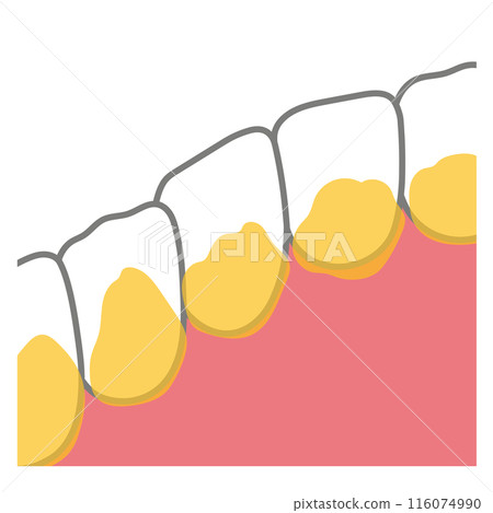 Plaque accumulated on the back of the front teeth, toothbrushing, unbrushed areas 116074990