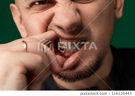 Man With Braces Making Silly Face Man With Braces Making Silly Face 116126445