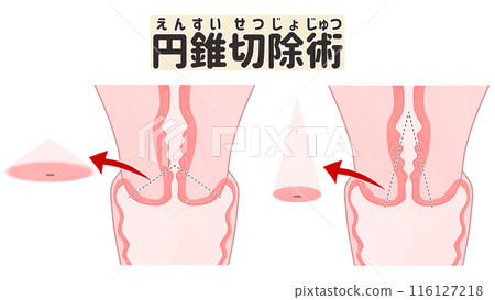 Cone biopsy - Cervical cancer - Easy-to-understand Japanese illustrations 116127218