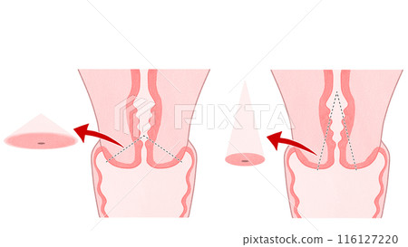 子宮頸錐狀切除術 簡單易懂的插圖 子宮頸錐狀切除術 簡單易懂的插圖 116127220