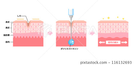 肉毒桿菌注射（肉毒桿菌）除皺機制/向量圖解 116132693