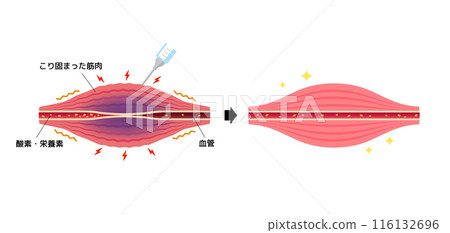 Mechanism of relieving stiffness through Botox injection (botulinum toxin) / Vector illustration Mechanism of relieving stiffness through Botox injection (botulinum toxin) / Vector illustration 116132696