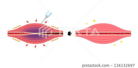肉毒桿菌注射(肉毒桿菌)緩解僵硬的機制/向量圖解 肉毒桿菌注射(肉毒桿菌)緩解僵硬的機制/向量圖解 116132697