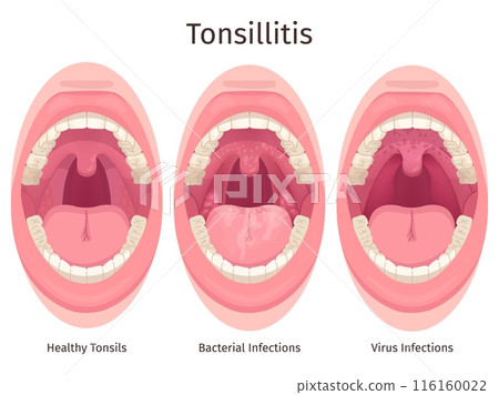 Tonsils. Human sore throat airways inflammation tonsil lymph and tongue in open mouth, bacteria swollen glands pharyngitis tonsillolith disease symptom, swanky illustration 116160022