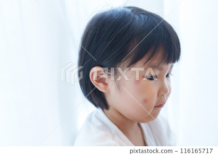 Child with insect bites on face 116165717