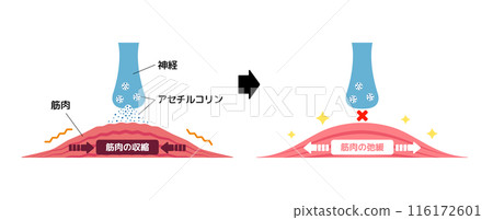 Mechanism of muscle relaxation by Botox injection (botulinum toxin) / Vector illustration 116172601