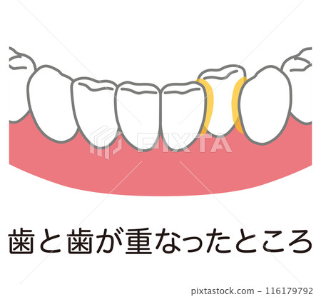 牙齒重疊處積聚的牙菌斑、牙膏、剩菜 116179792