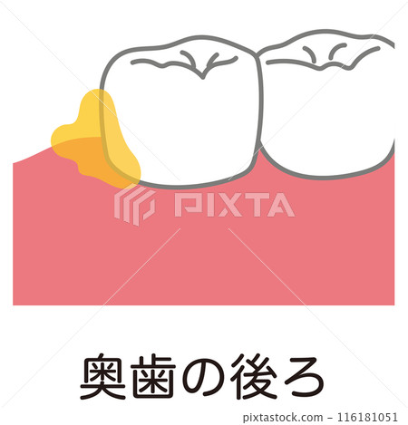 Plaque accumulated behind the back teeth, tooth brushing, brushing residue Plaque accumulated behind the back teeth, tooth brushing, brushing residue 116181051