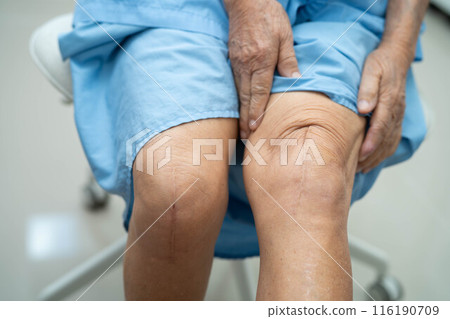 Asian elderly woman patient show her scars surgical total knee joint replacement Suture wound surgery arthroplasty. Asian elderly woman patient show her scars surgical total knee joint replacement Suture wound surgery arthroplasty. 116190709